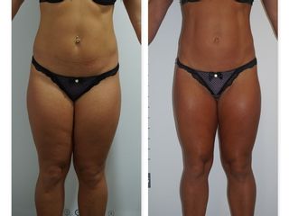 Antes y después Tratamiento de LPG + Radiofrecuencia