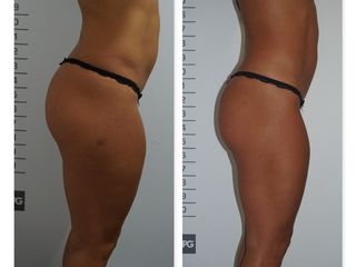 Antes y después Tratamiento de LPG + Radiofrecuencia