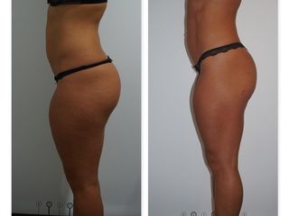 Antes y después Tratamiento de LPG + Radiofrecuencia