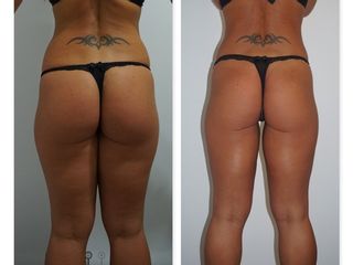Antes y después Tratamiento de LPG + Radiofrecuencia