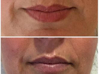 Aumento labios - 631665