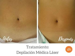 Antes y después Depilación láser