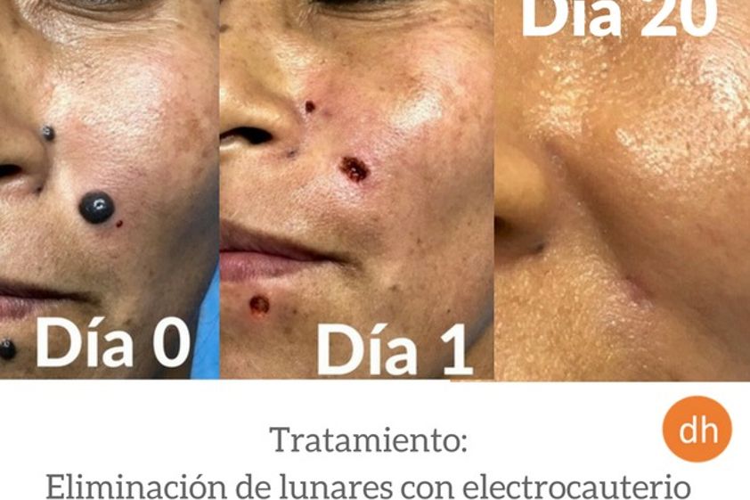 Lunares antes y después - 609477