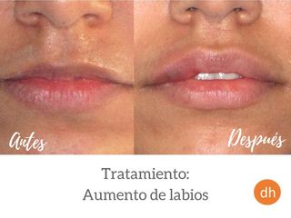 Antes y después Aumento de labios ¡Resultado natural!