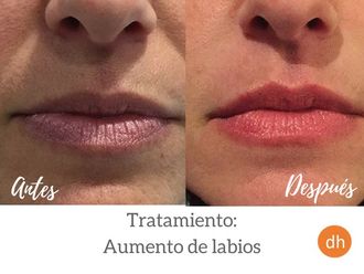 Aumento labios - 609485