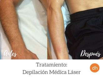 Depilacion Laser 26 Doctores Especialistas En Las Palmas Multiestetica Com