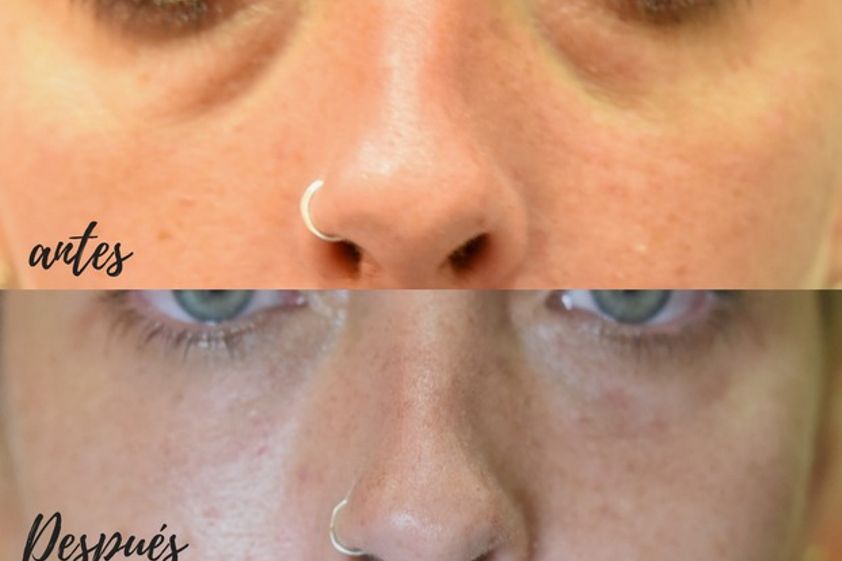Carboxiterapia antes y después - 617369