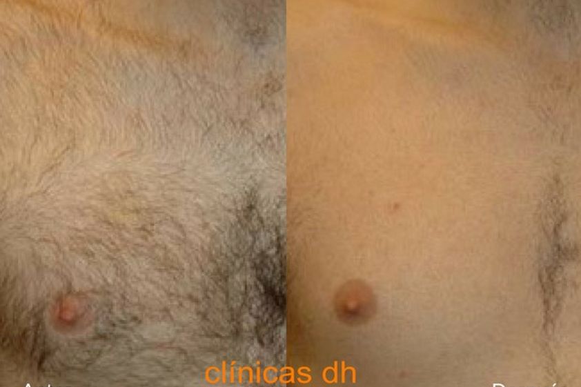Depilación láser antes y después - 626337