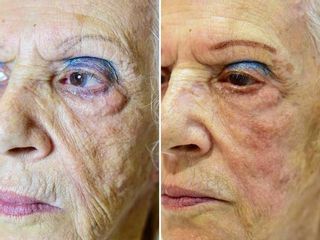 Antes y después Rellenos faciales