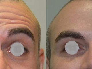 Antes y después Botox