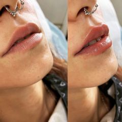 Antes y después Relleno de labios