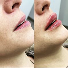Antes y después Relleno de labios