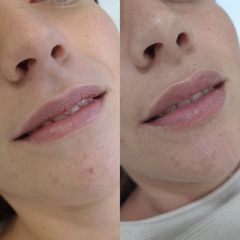 Aumento de labios - CLINICAS DH Clínicas Médico - Estéticas Zaragoza