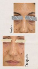Eliminación de ojeras - CLINICAS DH Clínicas Médico - Estéticas Zaragoza