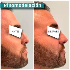 Rinomodelación - CLINICAS DH Clínicas Médico - Estéticas Zaragoza