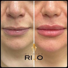 Aumento de labios - Clínica Rigo