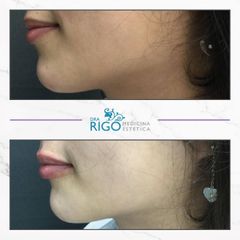 Aumento de labios - Clínica Rigo