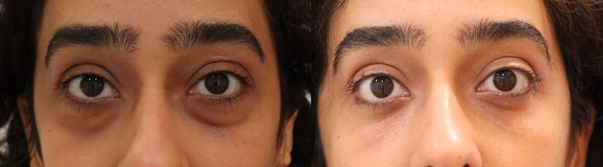 Blefaroplastia inferior transconjuntival
