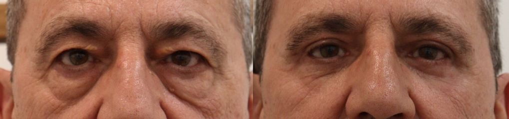 Blefaroplastia completa en hombre