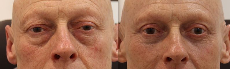 Blefaroplastia completa en hombre