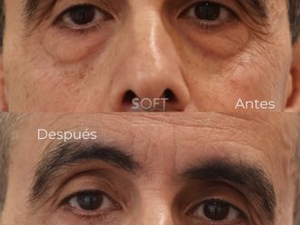 Blefaroplastia antes y después - 880338