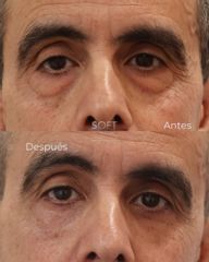 Blefaroplastia inferior