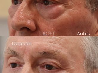 Blefaroplastia antes y después - 880339