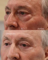 Blefaroplastia inferior