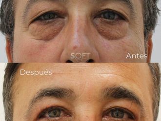Blefaroplastia antes y después - 880340