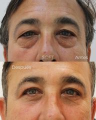 Blefaroplastia completa con resurfacing periocular