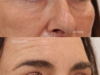 Blefaroplastia antes y después - 880341