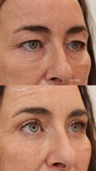 blefaroplastia completa + resurfacing periocular