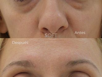 Blefaroplastia antes y después - 880342