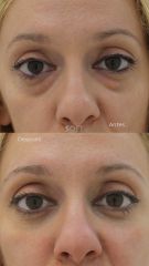 Blefaroplastia inferior transconjuntival