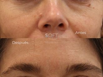Blefaroplastia antes y después - 880343