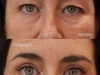 Blefaroplastia antes y después - 880344