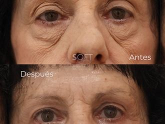 Blefaroplastia antes y después - 880345