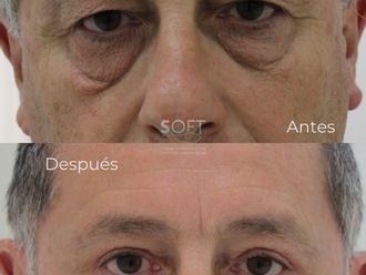Blefaroplastia antes y después - 880351