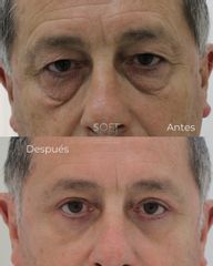 Blefaroplastia completa + resurfacing periocular
