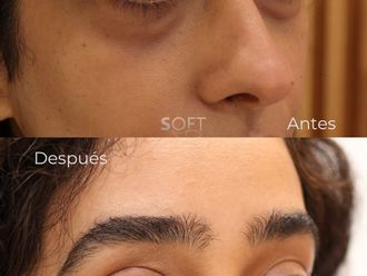 Blefaroplastia antes y después - 880352