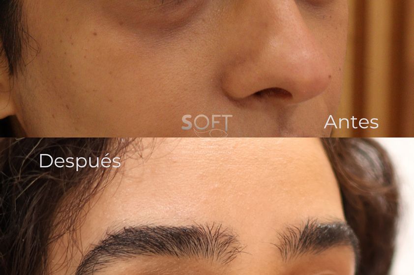 Blefaroplastia antes y después - 880352