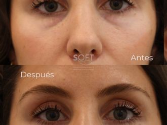 Blefaroplastia antes y después - 880353