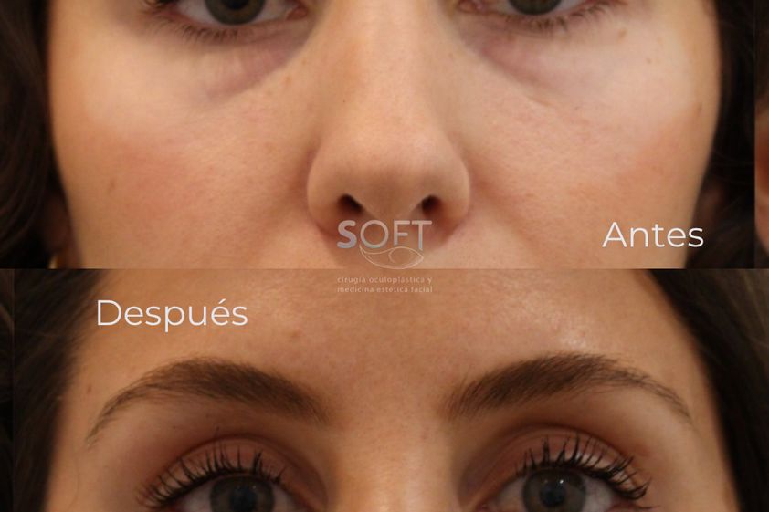 Blefaroplastia antes y después - 880353