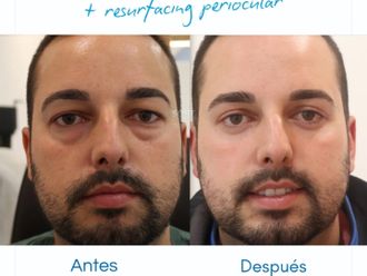 Blefaroplastia antes y después - 880481