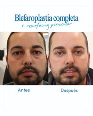 Hoy compartimos un caso de antes y después de blefaroplastia completa + resurfacing periocular de la
