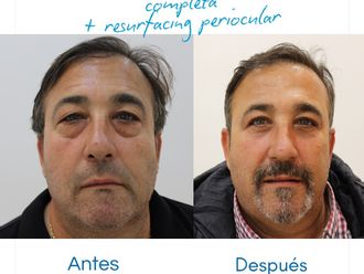 Blefaroplastia antes y después - 880482