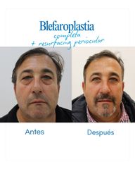 Antes y después de nuestro paciente: Blefaroplastia completa con resurfacing periocular