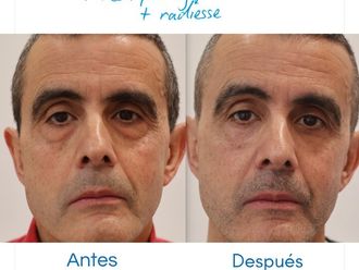 Blefaroplastia antes y después - 880483