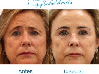 Blefaroplastia antes y después - 880484