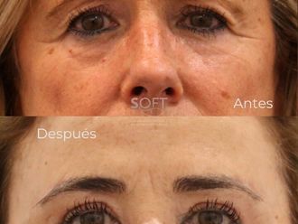 Blefaroplastia antes y después - 880485
